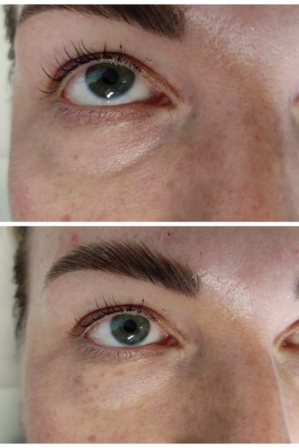 Before and after under-eye and brow enhancement at Queens Aesthetics, Chesterfield