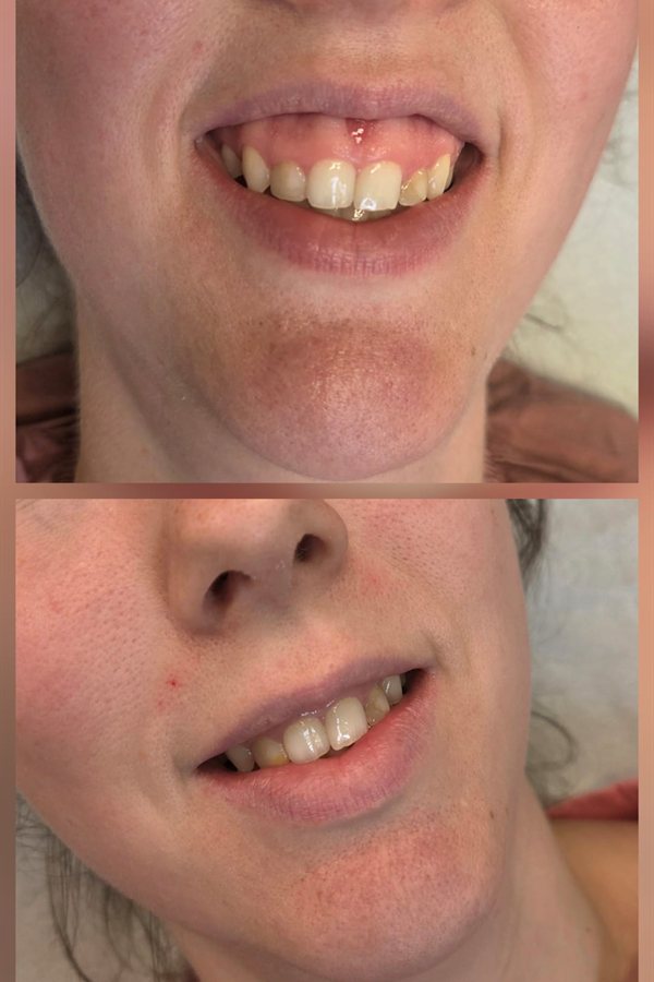 Before and after gummy smile treatment at Queens Aesthetics, Chesterfield