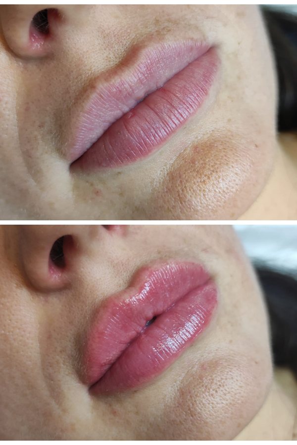 Before and after natural lip filler result at Queens Aesthetics, Chesterfield