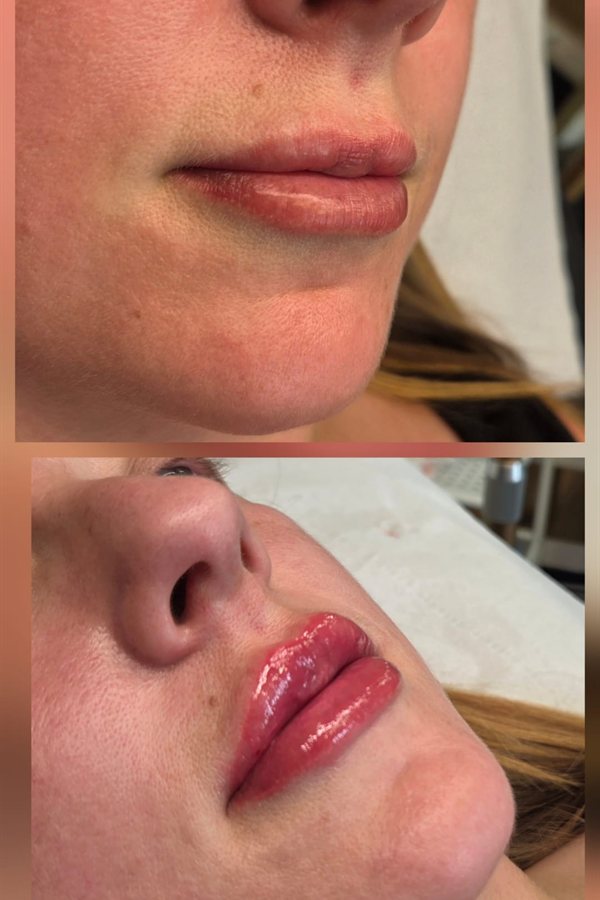 Before and after lip filler result at Queens Aesthetics, Chesterfield