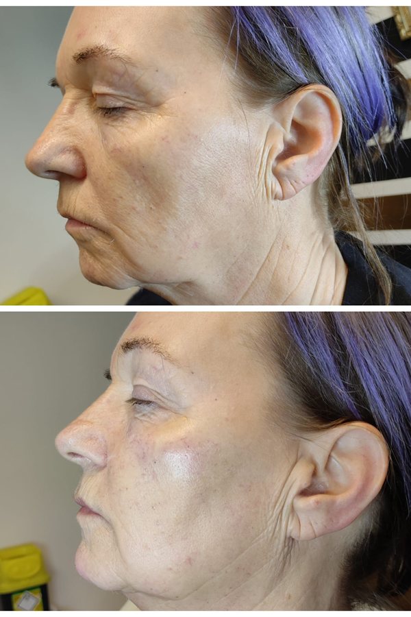 Before and after dermal filler result, side profile, at Queens Aesthetics, Chesterfield