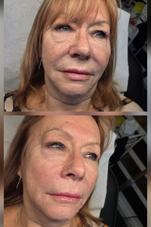 Before and after natural facial rejuvenation result at Queens Aesthetics, Chesterfield