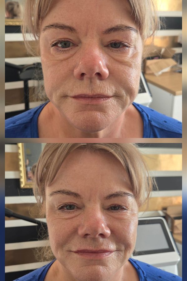 Before and after natural anti-ageing result at Queens Aesthetics, Chesterfield