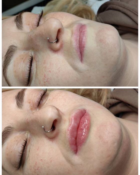 Natural lip filler result at Queens Aesthetics, Chesterfield